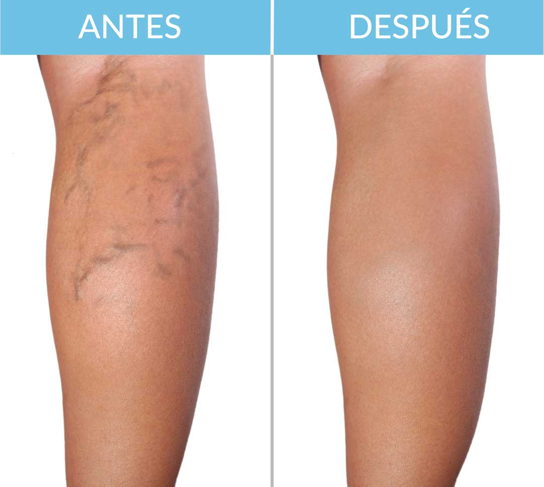🌸2x1 Di adiós a las molestias de las varices con nuestro innovador parche!