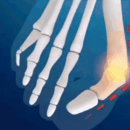 CORRECTOR DE JUANETES ORTOPEDICO