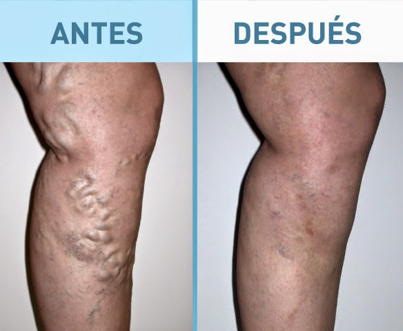 🌸2x1 Di adiós a las molestias de las varices con nuestro innovador parche!